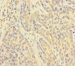 PAPPA / PAPP-A Antibody - Immunohistochemistry of paraffin-embedded human ovarian cancer using PAPPA Antibody at dilution of 1:100