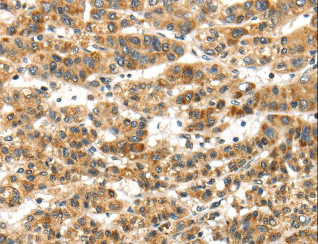 PAPPA / PAPP-A Antibody - Immunohistochemistry of paraffin-embedded Human thyroid cancer using PAPPA Polyclonal Antibody at dilution of 1:50.