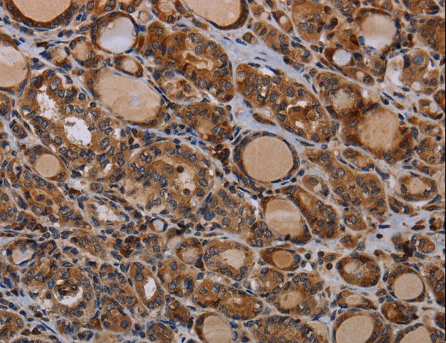 PAPPA / PAPP-A Antibody - Immunohistochemistry of paraffin-embedded Human thyroid cancer using PAPPA Polyclonal Antibody at dilution of 1:50.