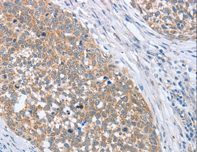 PAPSS 1 Antibody - Immunohistochemistry of paraffin-embedded Human gastric cancer using PAPSS1 Polyclonal Antibody at dilution of 1:40.