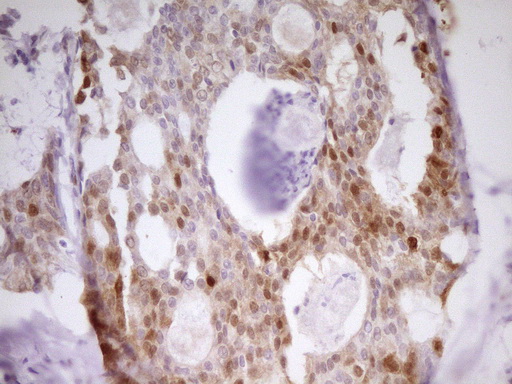 PAPSS2 Antibody - Immunohistochemical staining of paraffin-embedded Adenocarcinoma of Human breast tissue using anti-PAPSS2 mouse monoclonal antibody. (Heat-induced epitope retrieval by 1 mM EDTA in 10mM Tris, pH8.5, 120C for 3min,