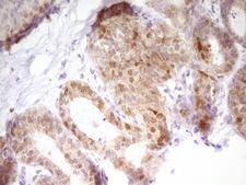 PAPSS2 Antibody - Immunohistochemical staining of paraffin-embedded Adenocarcinoma of Human breast tissue using anti-PAPSS2 mouse monoclonal antibody. (Heat-induced epitope retrieval by 1 mM EDTA in 10mM Tris, pH8.5, 120C for 3min,