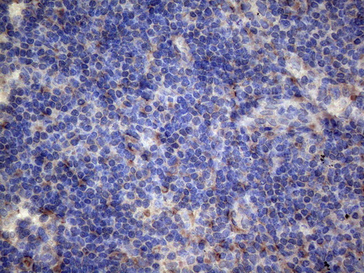 PAPSS2 Antibody - Immunohistochemical staining of paraffin-embedded Carcinoma of Human lung tissue using anti-PAPSS2 mouse monoclonal antibody. (Heat-induced epitope retrieval by 1mM EDTA in 10mM Tris buffer. (pH8.5) at 120°C for 3 min. (1:150)