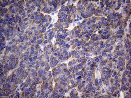 PAPSS2 Antibody - Immunohistochemical staining of paraffin-embedded Carcinoma of Human thyroid tissue using anti-PAPSS2 mouse monoclonal antibody. (Heat-induced epitope retrieval by 1mM EDTA in 10mM Tris buffer. (pH8.5) at 120°C for 3 min. (1:150)