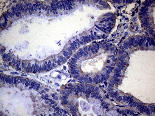 PAPSS2 Antibody - Immunohistochemical staining of paraffin-embedded Adenocarcinoma of Human endometrium tissue using anti-PAPSS2 mouse monoclonal antibody. (Heat-induced epitope retrieval by 1mM EDTA in 10mM Tris buffer. (pH8.5) at 120°C for 3 min. (1:150)