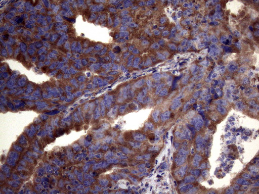 PAPSS2 Antibody - Immunohistochemical staining of paraffin-embedded Adenocarcinoma of Human colon tissue using anti-PAPSS2 mouse monoclonal antibody. (Heat-induced epitope retrieval by 1mM EDTA in 10mM Tris buffer. (pH8.5) at 120°C for 3 min. (1:150)
