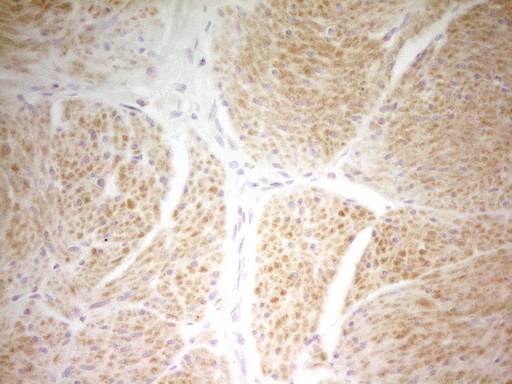 PAPSS2 Antibody - Immunohistochemical staining of paraffin-embedded Carcinoma of Human bladder tissue using anti-PAPSS2 mouse monoclonal antibody. (Heat-induced epitope retrieval by 1 mM EDTA in 10mM Tris, pH8.5, 120C for 3min,