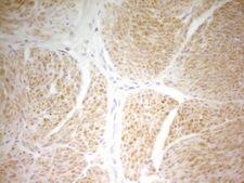 PAPSS2 Antibody - IHC of paraffin-embedded Carcinoma of Human bladder tissue using anti-PAPSS2 mouse monoclonal antibody. (Heat-induced epitope retrieval by 1 mM EDTA in 10mM Tris, pH8.5, 120°C for 3min).