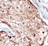PAPSS2 Antibody - Formalin-fixed and paraffin-embedded human cancer tissue reacted with the primary antibody, which was peroxidase-conjugated to the secondary antibody, followed by AEC staining. This data demonstrates the use of this antibody for immunohistochemistry; clinical relevance has not been evaluated. BC = breast carcinoma; HC = hepatocarcinoma.