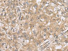 PAPSS2 Antibody - Immunohistochemistry of paraffin-embedded Human liver cancer tissue  using PAPSS2 Polyclonal Antibody at dilution of 1:60(×200)