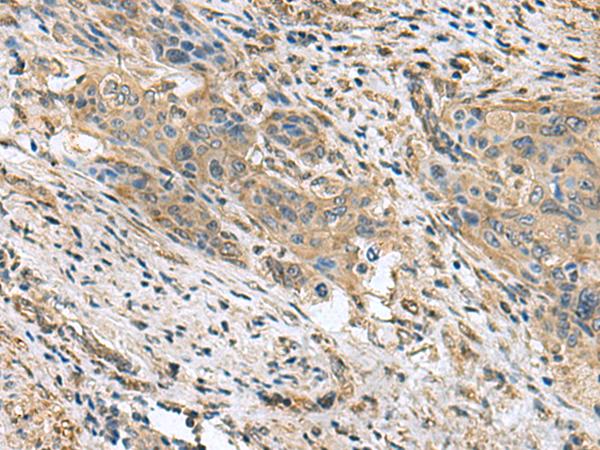 PAPSS2 Antibody - Immunohistochemistry of paraffin-embedded Human cervical cancer tissue  using PAPSS2 Polyclonal Antibody at dilution of 1:60(×200)
