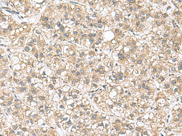 PAPSS2 Antibody - Immunohistochemistry of paraffin-embedded Human liver cancer tissue  using PAPSS2 Polyclonal Antibody at dilution of 1:95(×200)
