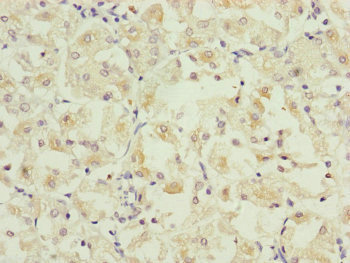PAR6B / PARD6B Antibody - Immunohistochemistry of paraffin-embedded human gastric cancer at dilution of 1:100