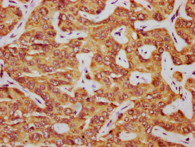 PAR6B / PARD6B Antibody - IHC image of PARD6B Antibody diluted at 1:325 and staining in paraffin-embedded human liver cancer performed on a Leica BondTM system. After dewaxing and hydration, antigen retrieval was mediated by high pressure in a citrate buffer (pH 6.0). Section was blocked with 10% normal goat serum 30min at RT. Then primary antibody (1% BSA) was incubated at 4°C overnight. The primary is detected by a biotinylated secondary antibody and visualized using an HRP conjugated SP system.