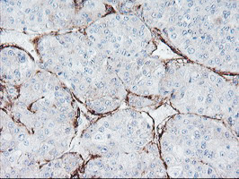 Paraplegin / SPG7 Antibody - IHC of paraffin-embedded Carcinoma of Human liver tissue using anti-SPG7 mouse monoclonal antibody. (Heat-induced epitope retrieval by 10mM citric buffer, pH6.0, 120°C for 3min).