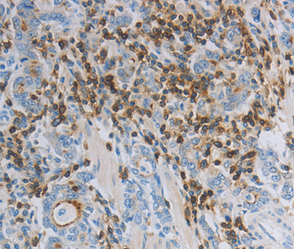 PARD6A / PAR6 Antibody - Immunohistochemistry of paraffin-embedded human gastric cancer tissue.