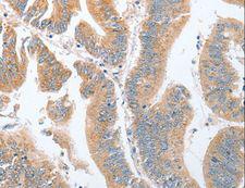 PARD6A / PAR6 Antibody - Immunohistochemistry of paraffin-embedded Human breast cancer using PARD6A Polyclonal Antibody at dilution of 1:60.