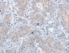 PARD6A / PAR6 Antibody - Immunohistochemistry of paraffin-embedded Human liver cancer using PARD6A Polyclonal Antibody at dilution of 1:60.