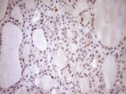 PARG Antibody - Immunohistochemical staining of paraffin-embedded Human thyroid tissue within the normal limits using anti-PARG mouse monoclonal antibody. (Heat-induced epitope retrieval by 1mM EDTA in 10mM Tris buffer. (pH8.5) at 120°C for 3 min. (1:150)