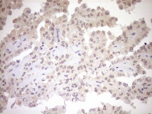 PARG Antibody - Immunohistochemical staining of paraffin-embedded Carcinoma of Human thyroid tissue using anti-PARG mouse monoclonal antibody. (Heat-induced epitope retrieval by 1mM EDTA in 10mM Tris buffer. (pH8.5) at 120°C for 3 min. (1:150)