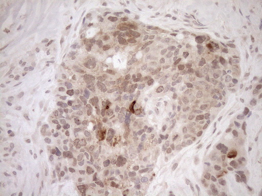 PARG Antibody - Immunohistochemical staining of paraffin-embedded Adenocarcinoma of Human endometrium tissue using anti-PARG mouse monoclonal antibody. (Heat-induced epitope retrieval by 1mM EDTA in 10mM Tris buffer. (pH8.5) at 120°C for 3 min. (1:150)