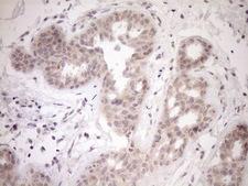 PARG Antibody - Immunohistochemical staining of paraffin-embedded Adenocarcinoma of Human breast tissue using anti-PARG mouse monoclonal antibody. (Heat-induced epitope retrieval by 1mM EDTA in 10mM Tris buffer. (pH8.5) at 120°C for 3 min. (1:150)