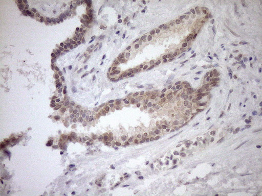 PARG Antibody - Immunohistochemical staining of paraffin-embedded Carcinoma of Human prostate tissue using anti-PARG mouse monoclonal antibody. (Heat-induced epitope retrieval by 1mM EDTA in 10mM Tris buffer. (pH8.5) at 120°C for 3 min. (1:150)