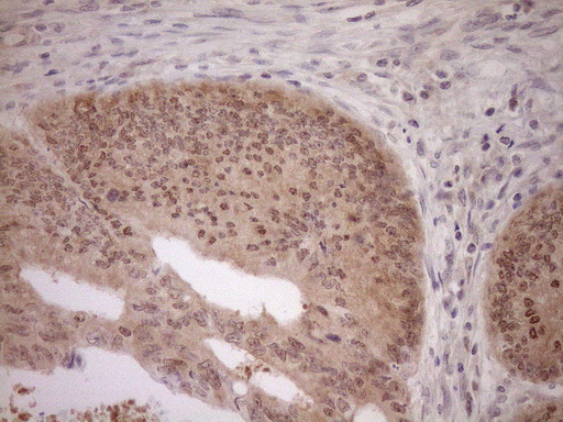 PARG Antibody - Immunohistochemical staining of paraffin-embedded Adenocarcinoma of Human colon tissue using anti-PARG mouse monoclonal antibody. (Heat-induced epitope retrieval by 1mM EDTA in 10mM Tris buffer. (pH8.5) at 120°C for 3 min. (1:150)