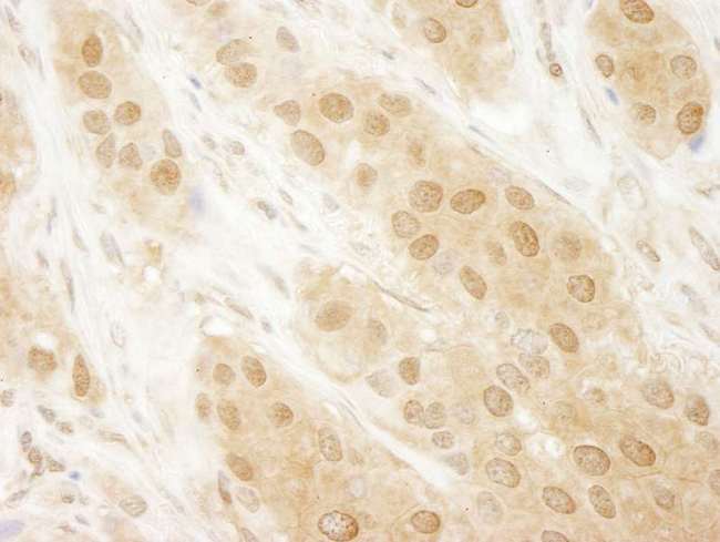 PARK7 / DJ-1 Antibody - Detection of Human DJ-1 by Immunohistochemistry. Sample: FFPE section of human breast carcinoma. Antibody: Affinity purified rabbit anti-DJ-1 used at a dilution of 1:250. Epitope Retrieval Buffer-High pH (IHC-101J) was substituted for Epitope Retrieval Buffer-Reduced pH.