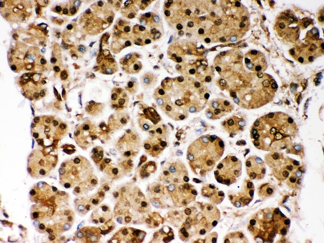 PARK7 / DJ-1 Antibody - PARK7 antibody IHC-paraffin: Human Pancreatic Cancer Tissue.