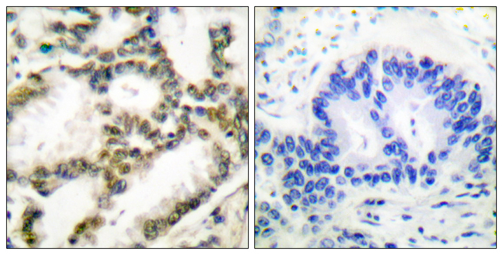 PARK7 / DJ-1 Antibody - Immunohistochemistry analysis of paraffin-embedded human lung carcinoma tissue, using DJ-1 Antibody. The picture on the right is blocked with the synthesized peptide.