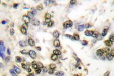 PARK7 / DJ-1 Antibody - IHC of DJ-1/PARK7 (P54) pAb in paraffin-embedded human lung carcinoma tissue.