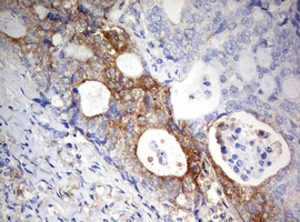 PARN Antibody - IHC of paraffin-embedded Adenocarcinoma of Human breast tissue using anti-PARN mouse monoclonal antibody. (Heat-induced epitope retrieval by 10mM citric buffer, pH6.0, 120°C for 3min).