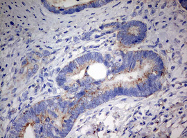 PARN Antibody - IHC of paraffin-embedded Adenocarcinoma of Human colon tissue using anti-PARN mouse monoclonal antibody. (Heat-induced epitope retrieval by 10mM citric buffer, pH6.0, 120°C for 3min).