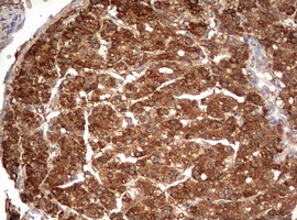 PARN Antibody - IHC of paraffin-embedded Carcinoma of Human liver tissue using anti-PARN mouse monoclonal antibody. (Heat-induced epitope retrieval by 10mM citric buffer, pH6.0, 120°C for 3min).