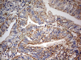 PARN Antibody - IHC of paraffin-embedded Adenocarcinoma of Human endometrium tissue using anti-PARN mouse monoclonal antibody. (Heat-induced epitope retrieval by 10mM citric buffer, pH6.0, 120°C for 3min).