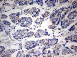 PARN Antibody - IHC of paraffin-embedded Carcinoma of Human bladder tissue using anti-PARN mouse monoclonal antibody. (Heat-induced epitope retrieval by 10mM citric buffer, pH6.0, 120°C for 3min).