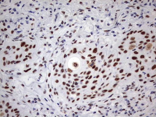 PARN Antibody - Immunohistochemical staining of paraffin-embedded Carcinoma of Human lung tissue using anti-PARNmouse monoclonal antibody.  heat-induced epitope retrieval by 10mM citric buffer, pH9.0, 120C for 3min)