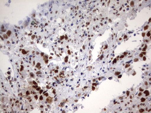 PARN Antibody - Immunohistochemical staining of paraffin-embedded Adenocarcinoma of Human ovary tissue using anti-PARN mouse monoclonal antibody.  heat-induced epitope retrieval by 10mM citric buffer, pH9.0, 120C for 3min)