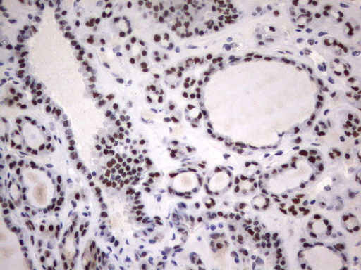 PARN Antibody - Immunohistochemical staining of paraffin-embedded Carcinoma of Human thyroid tissue using anti-PARN mouse monoclonal antibody.  heat-induced epitope retrieval by 10mM citric buffer, pH9.0, 120C for 3min)