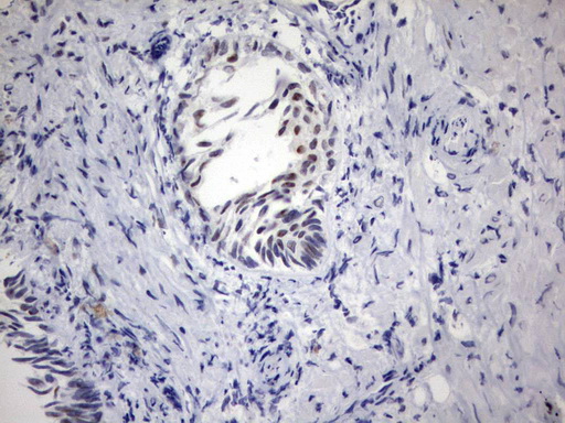 PARN Antibody - Immunohistochemical staining of paraffin-embedded Human prostate tissue using anti-PARN mouse monoclonal antibody.  heat-induced epitope retrieval by 10mM citric buffer, pH9.0, 120C for 3min)