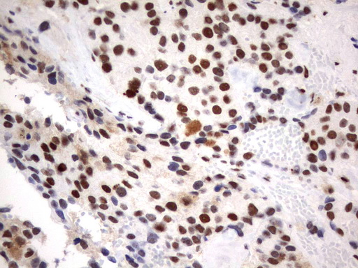 PARN Antibody - Immunohistochemical staining of paraffin-embedded Adenocarcinoma of Human breast tissue using anti-PARN mouse monoclonal antibody.  heat-induced epitope retrieval by 10mM citric buffer, pH9.0, 120C for 3min)