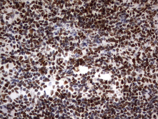 PARN Antibody - Immunohistochemical staining of paraffin-embedded Human lymphoma tissue using anti-PARN mouse monoclonal antibody.  heat-induced epitope retrieval by 10mM citric buffer, pH9.0, 120C for 3min)