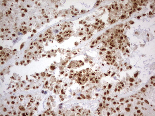 PARN Antibody - Immunohistochemical staining of paraffin-embedded Adenocarcinoma of Human colon tissue using anti-PARN mouse monoclonal antibody.  heat-induced epitope retrieval by 10mM citric buffer, pH9.0, 120C for 3min)
