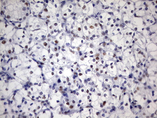 PARN Antibody - Immunohistochemical staining of paraffin-embedded Carcinoma of Human kidney tissue using anti-PARN mouse monoclonal antibody.  heat-induced epitope retrieval by 10mM citric buffer, pH9.0, 120C for 3min)