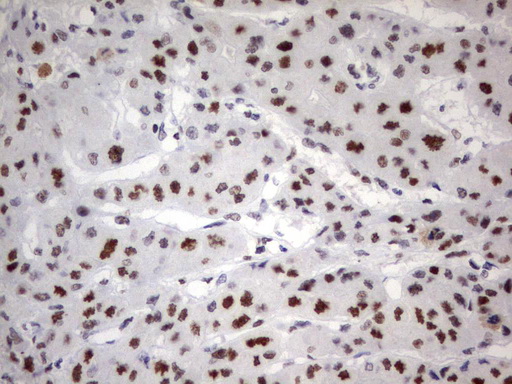 PARN Antibody - Immunohistochemical staining of paraffin-embedded Carcinoma of Human liver tissue using anti-PARNmouse monoclonal antibody.  heat-induced epitope retrieval by 10mM citric buffer, pH9.0, 120C for 3min)