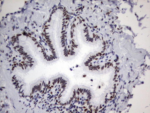 PARN Antibody - Immunohistochemical staining of paraffin-embedded Human lung tissue using anti-PARN mouse monoclonal antibody.  heat-induced epitope retrieval by 10mM citric buffer, pH9.0, 120C for 3min)