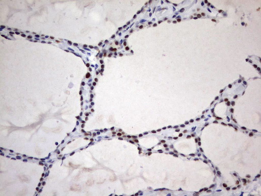 PARN Antibody - Immunohistochemical staining of paraffin-embedded Human thyroid tissue using anti-PARN mouse monoclonal antibody.  heat-induced epitope retrieval by 10mM citric buffer, pH9.0, 120C for 3min)