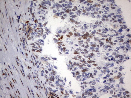 PARN Antibody - Immunohistochemical staining of paraffin-embedded Adenocarcinoma of Human endometrium tissue using anti-PARN mouse monoclonal antibody.  heat-induced epitope retrieval by 10mM citric buffer, pH9.0, 120C for 3min)