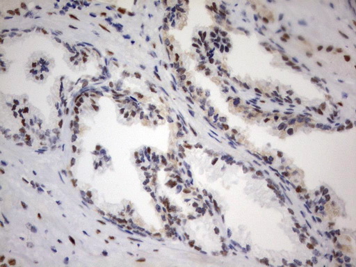 PARN Antibody - Immunohistochemical staining of paraffin-embedded Carcinoma of Human prostate tissue using anti-PARN mouse monoclonal antibody.  heat-induced epitope retrieval by 10mM citric buffer, pH9.0, 120C for 3min)